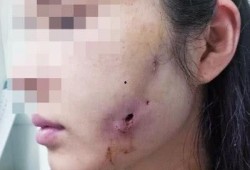 郑州整形失败爆料案件最新,揭秘美容行业潜规则与维权困境